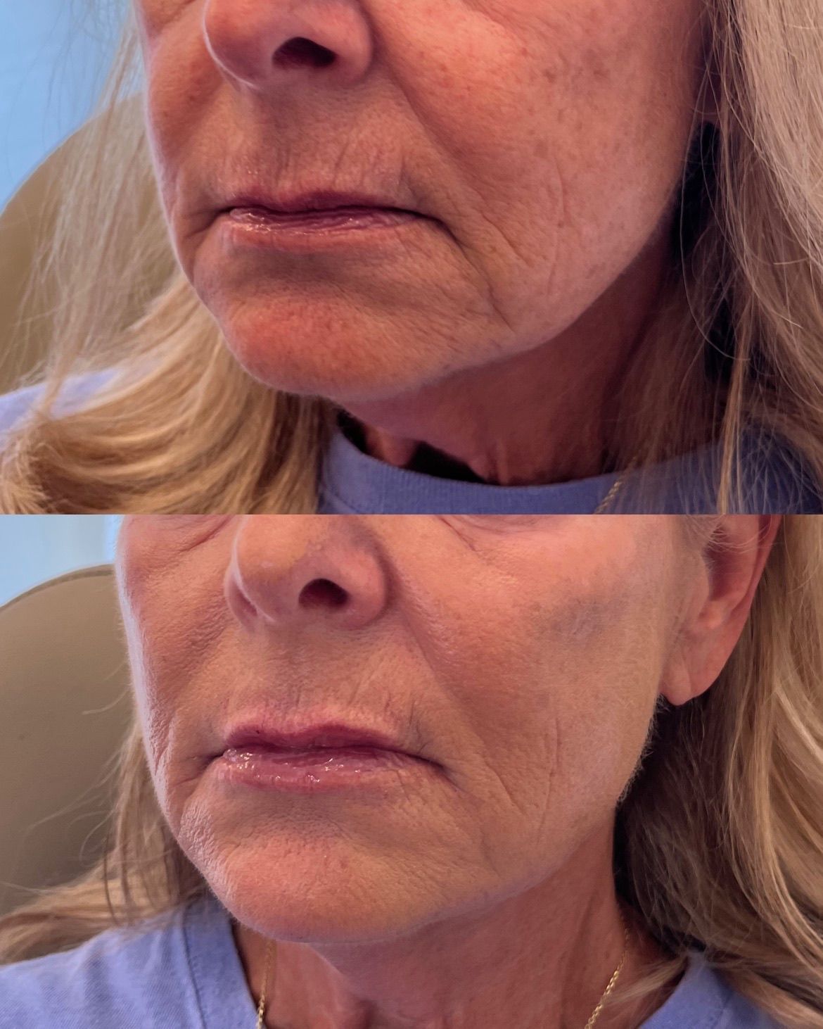 Close-up comparison of a woman’s lower face and neck, showing two different skin tones and lighting levels.