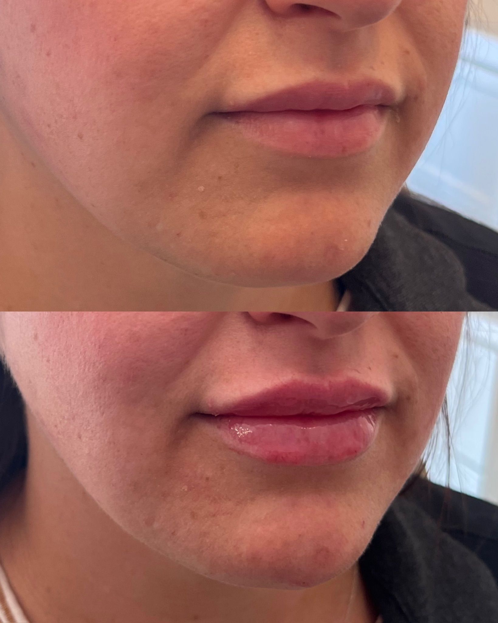 Split close-up of a person’s lower face before and after lip filler, showing fuller lips on the bottom.