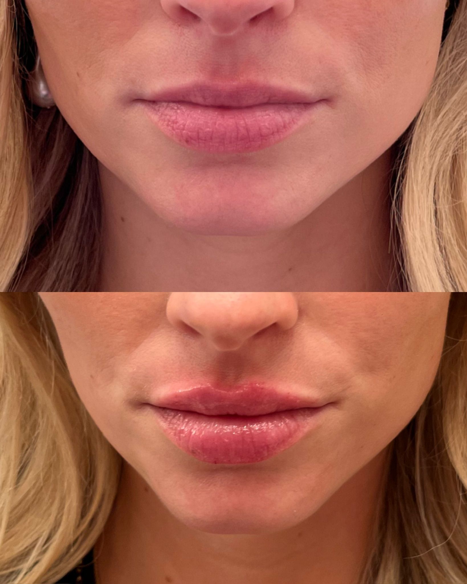 Close-up before and after comparison of two lower faces.