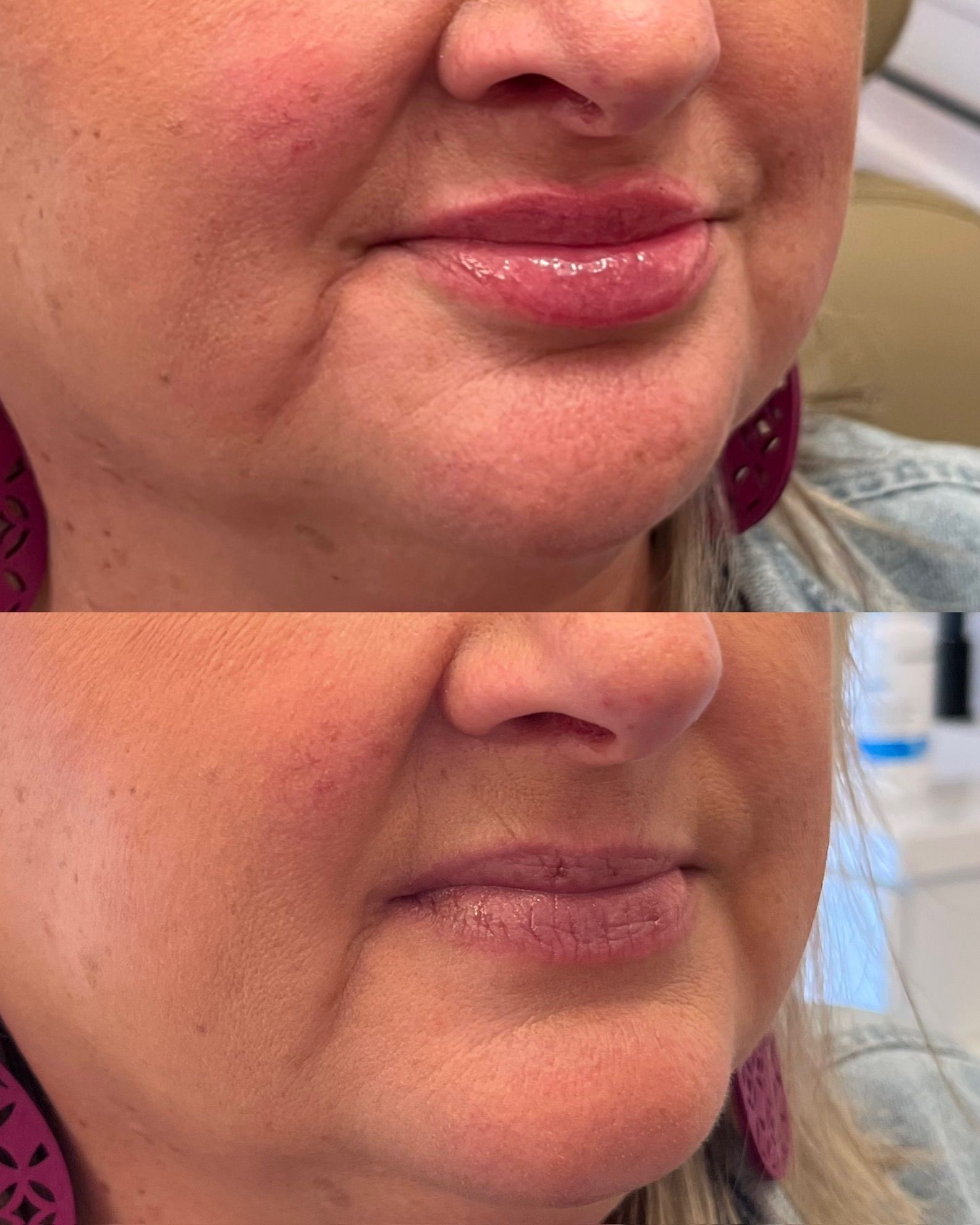 Close-up of lips before and after treatment, showing smoother, fuller appearance at a clinic.