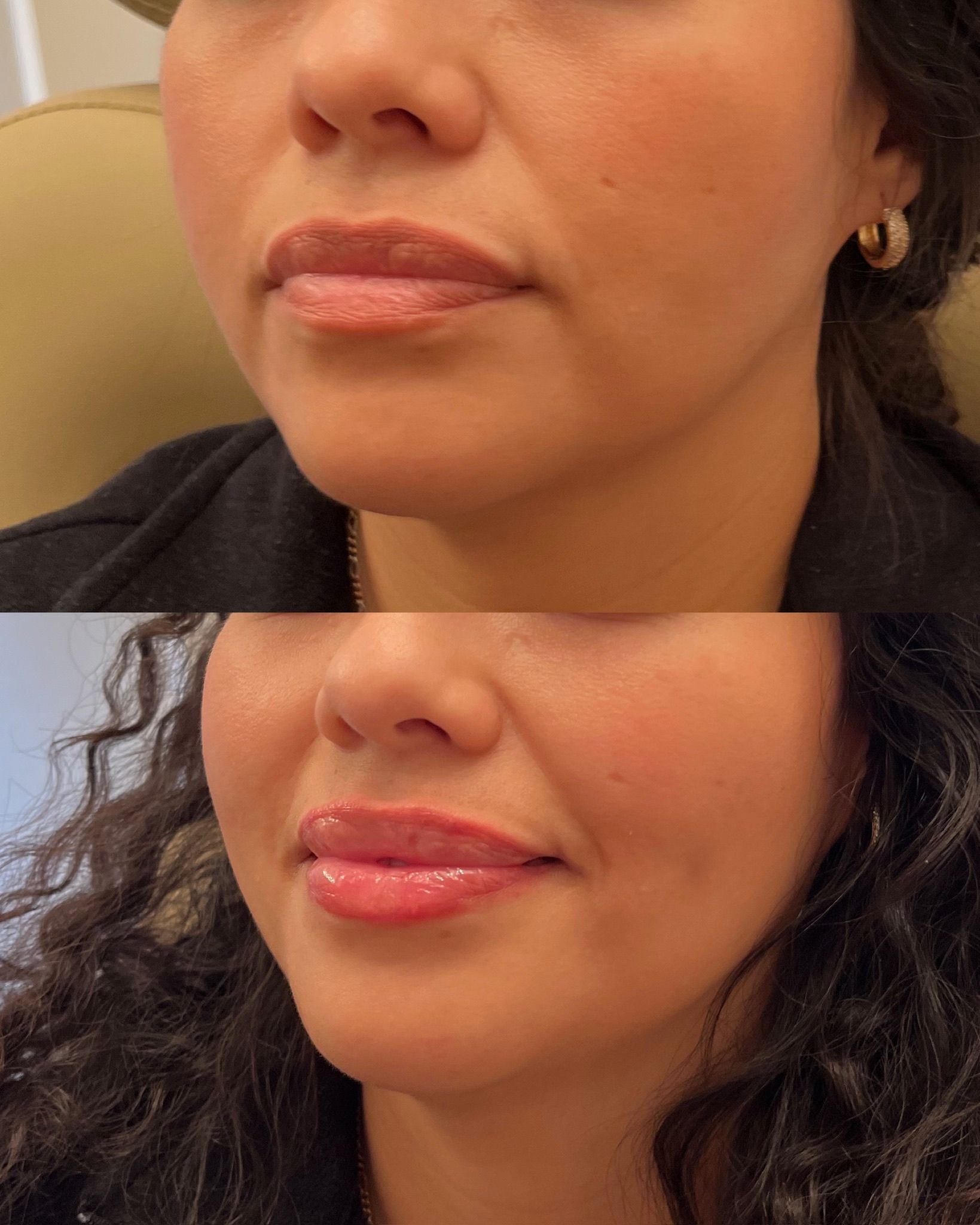 Close-up of a woman’s face showing her chin and lower cheeks, with two side-by-side before and after.
