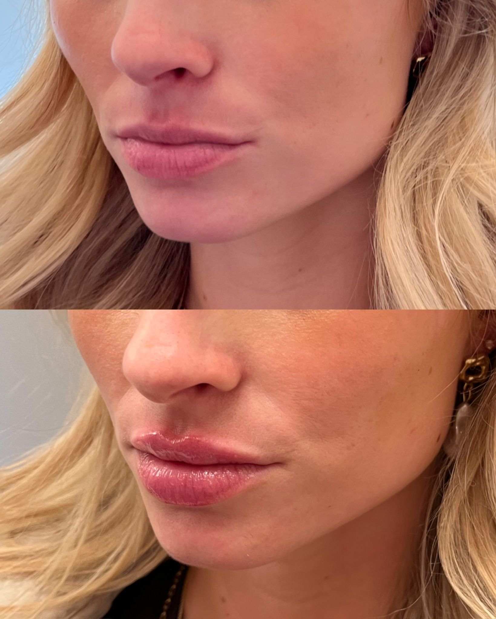 Close-up before-and-after of a person’s lips and nose.