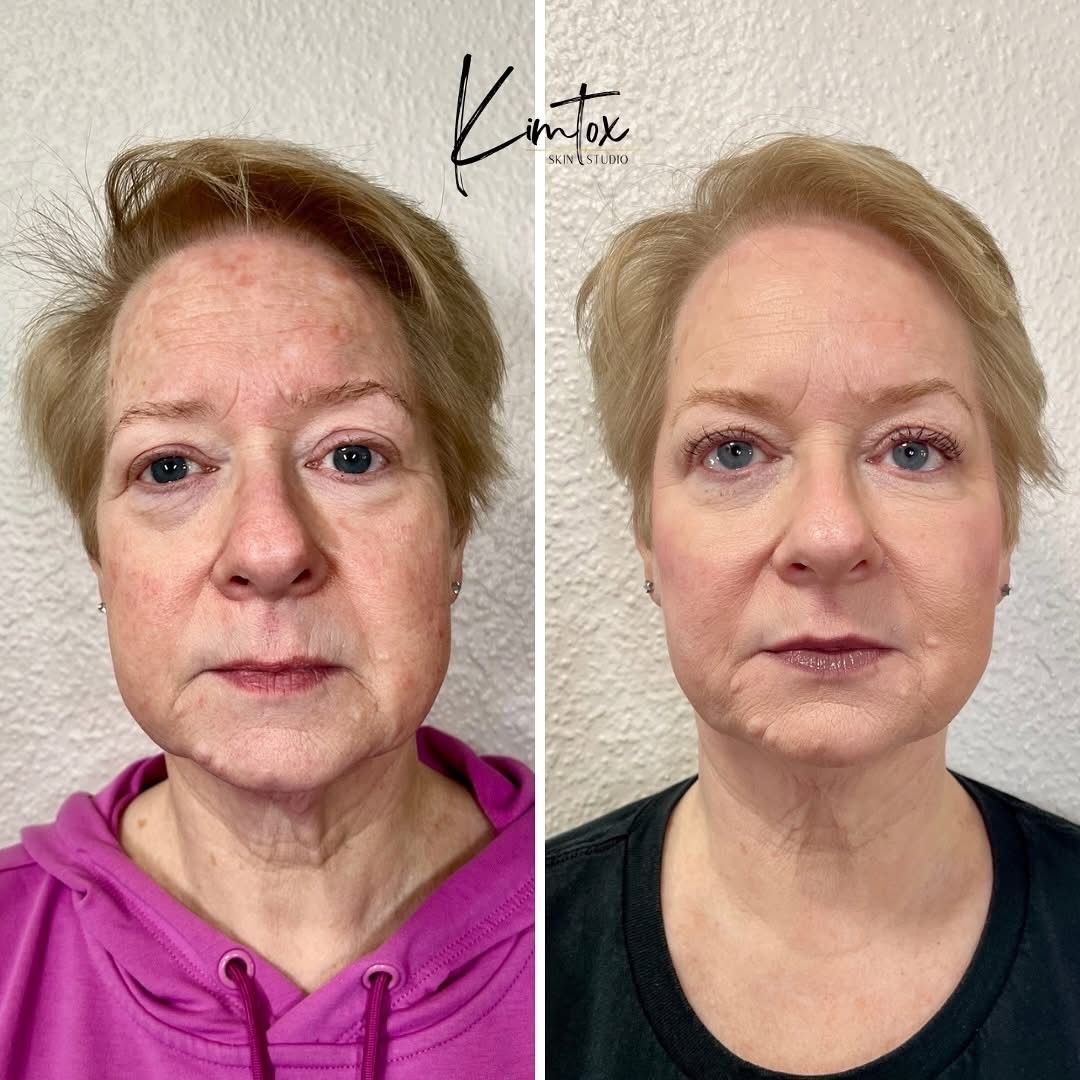 Side-by-side face comparison showing a woman before and after.