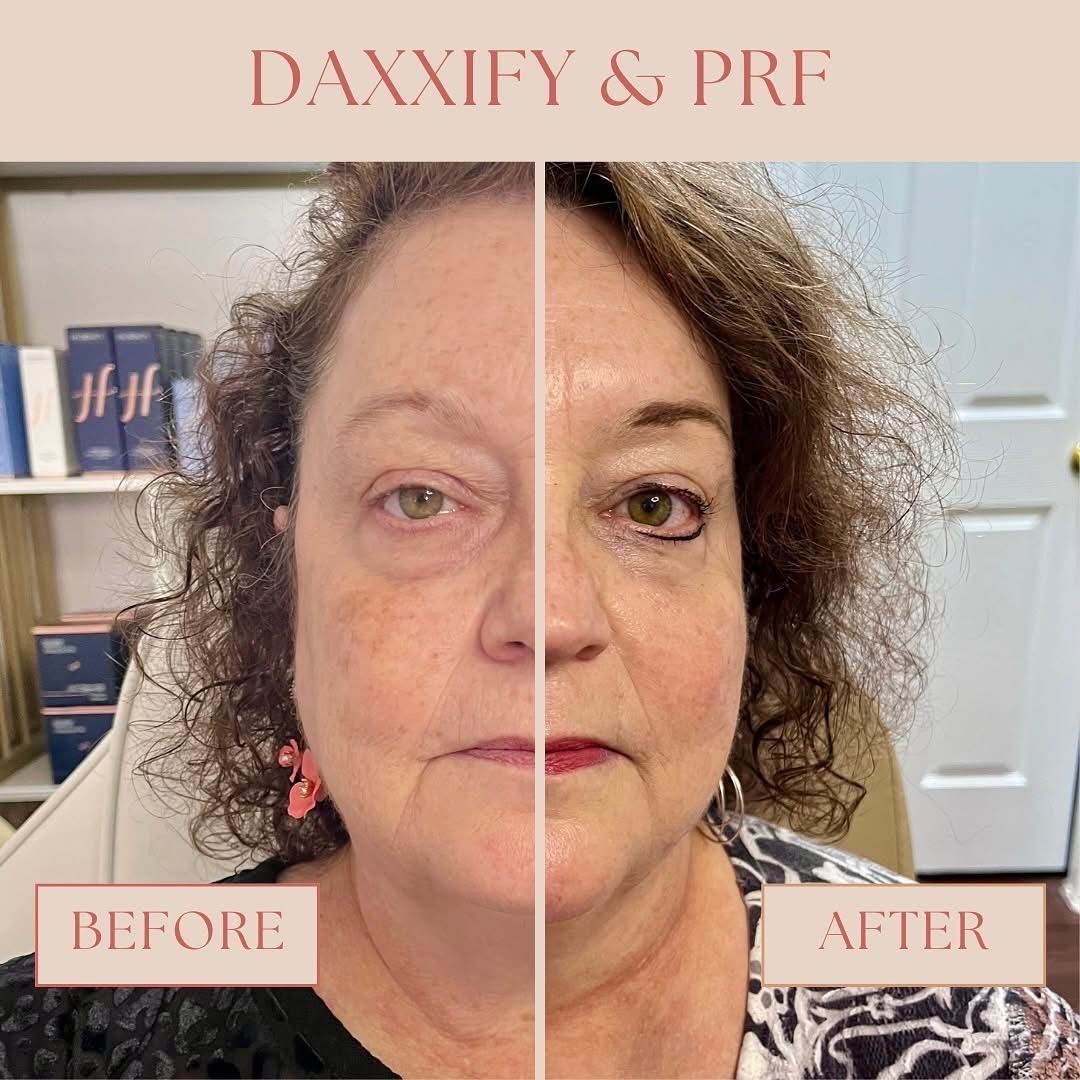 Split before-and-after portrait of a woman with visible skin improvement, labeled “BEFORE” and “AFTER.”