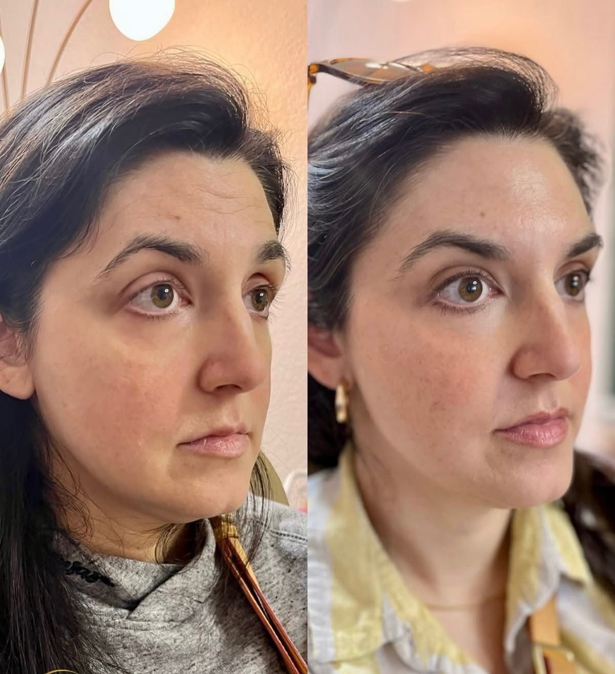 Side-by-side portrait of a woman in profile, showing a before-and-after.
