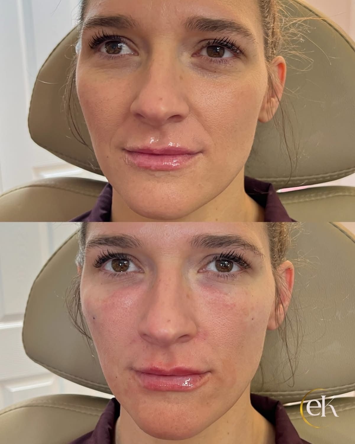 Two close-up facial photos stacked vertically, showing a woman before and after lip filler.