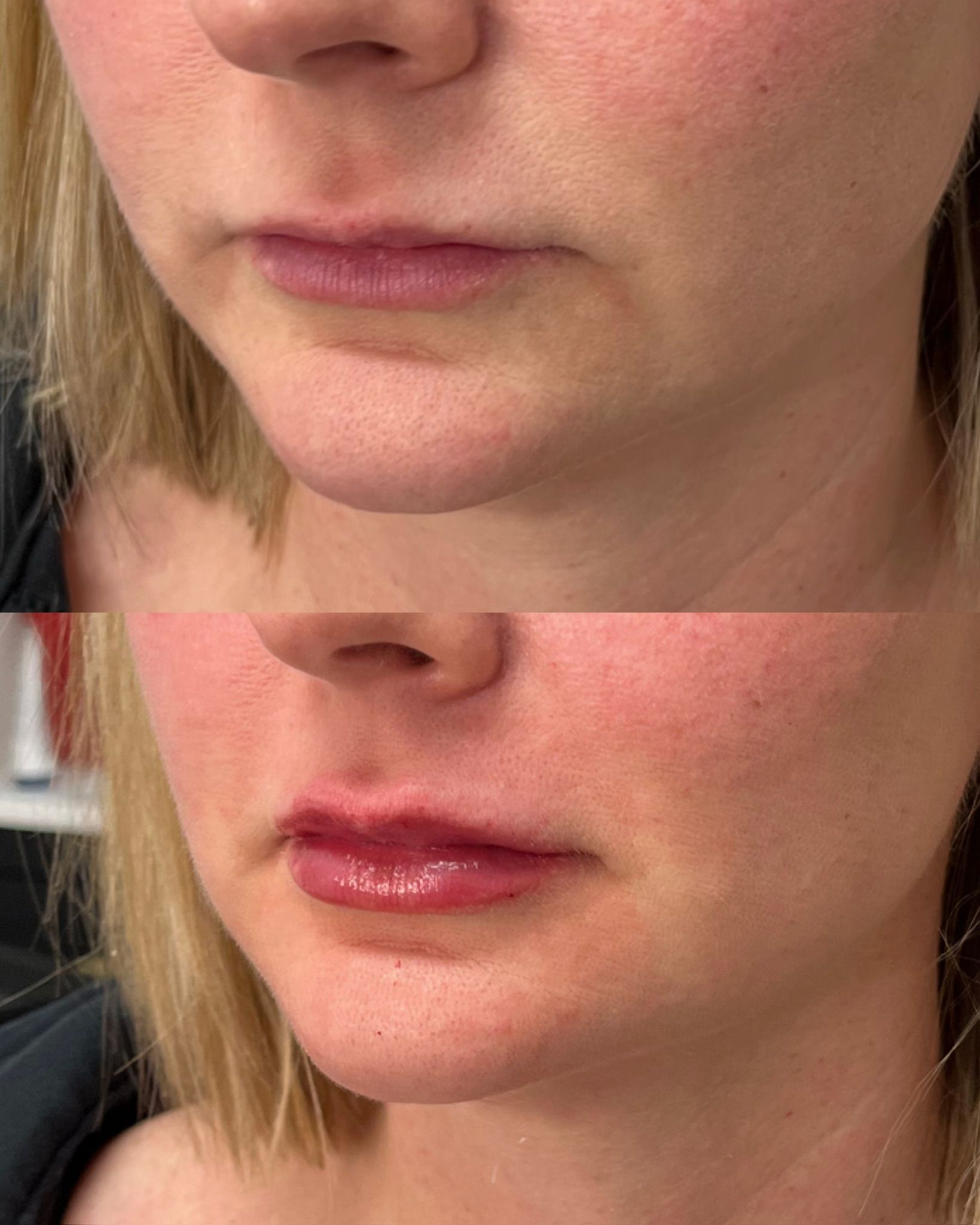 Close-up of a woman’s lower face with before and after.