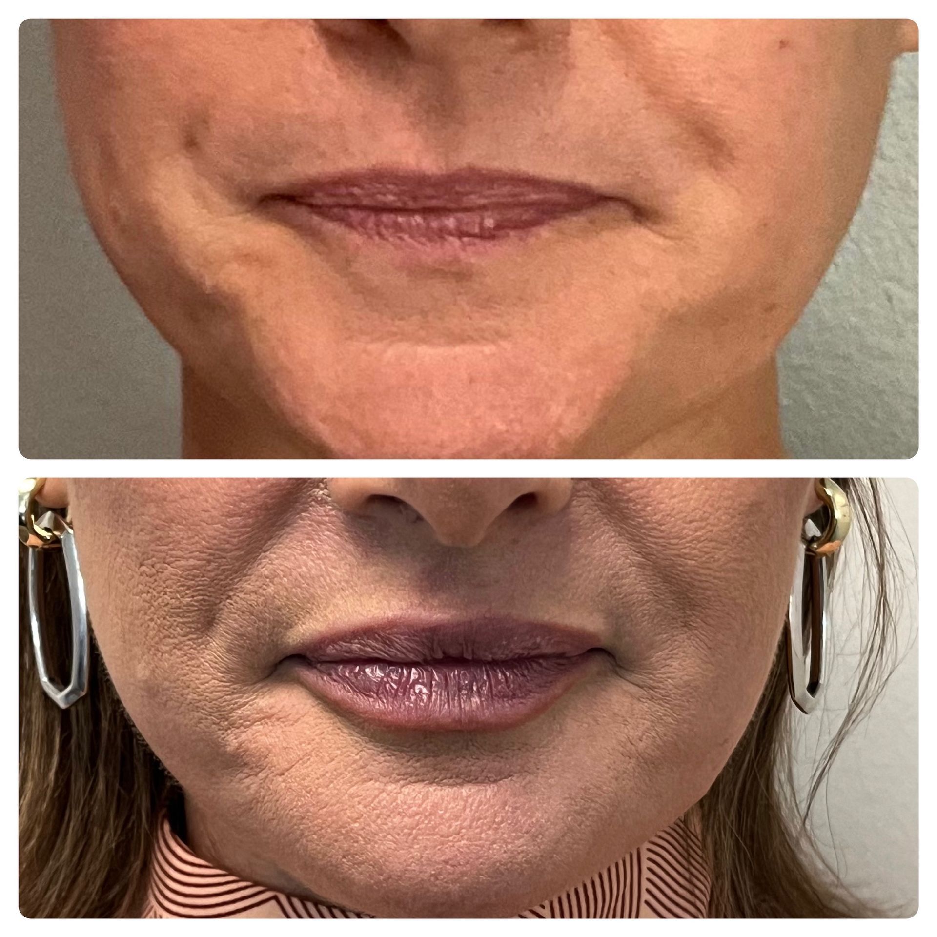 Split-screen close-up of lips and chin before and after.