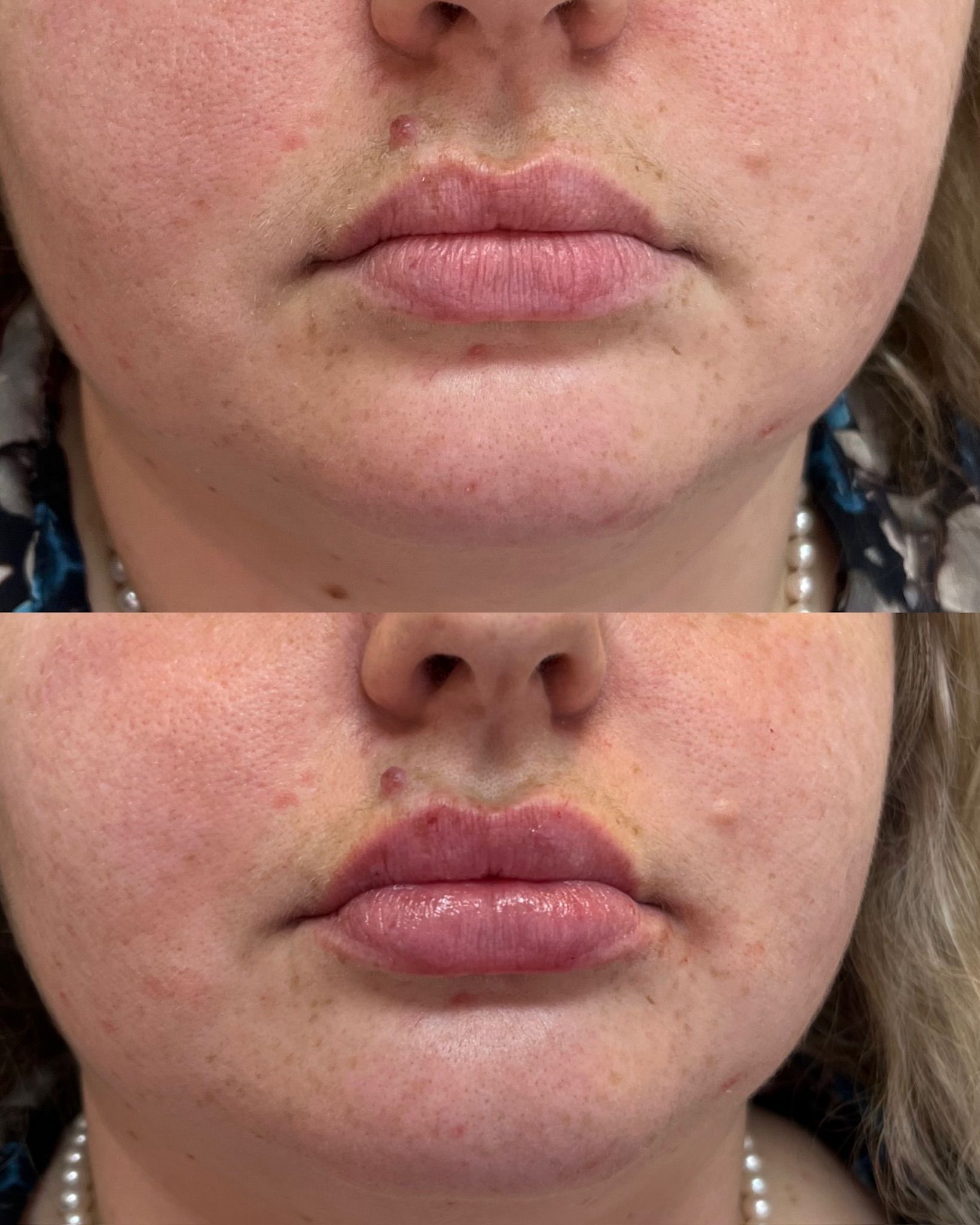 Close-up of a lower face before and after.
