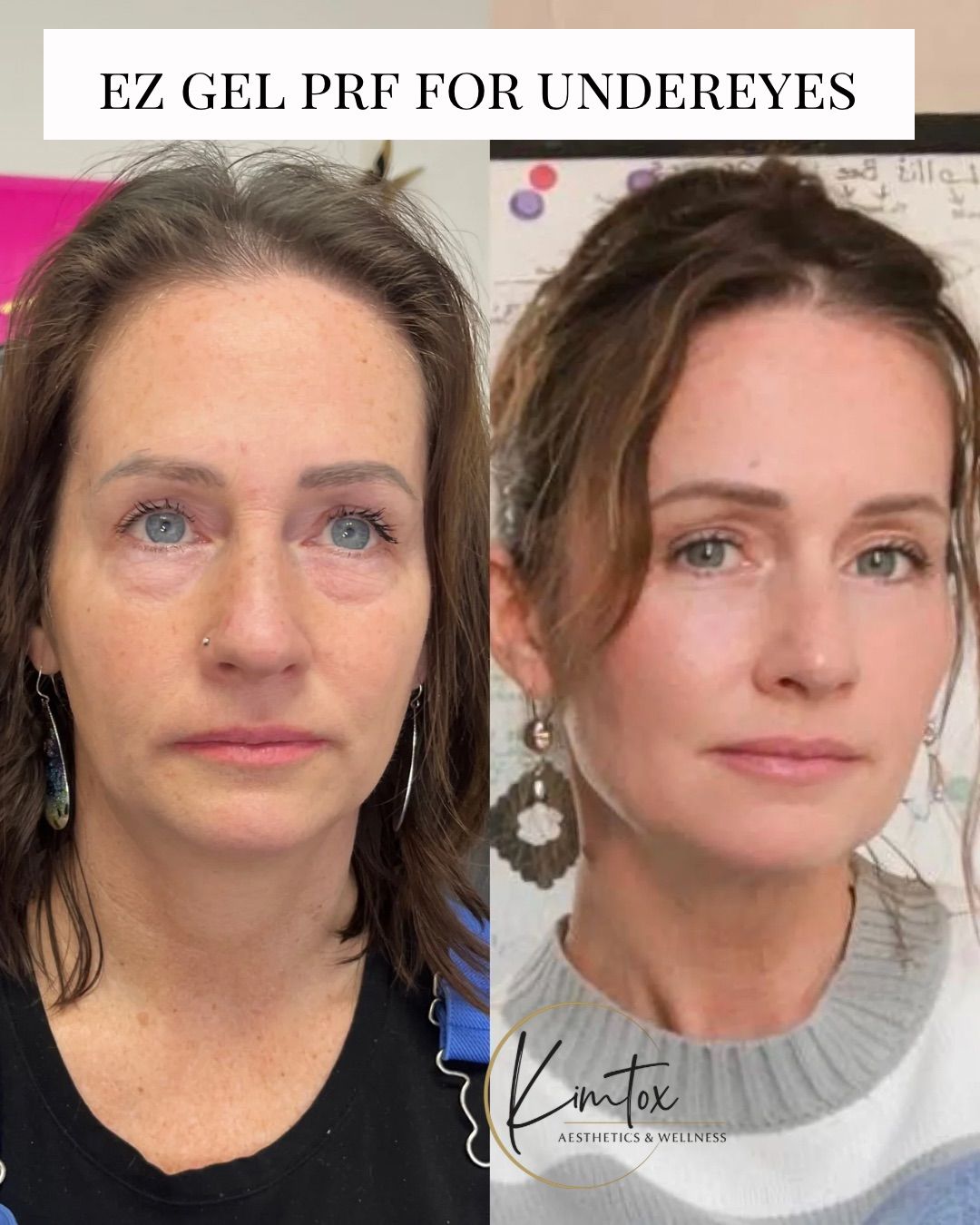 Before-and-after portrait showing under-eye gel PRF results on the same woman.