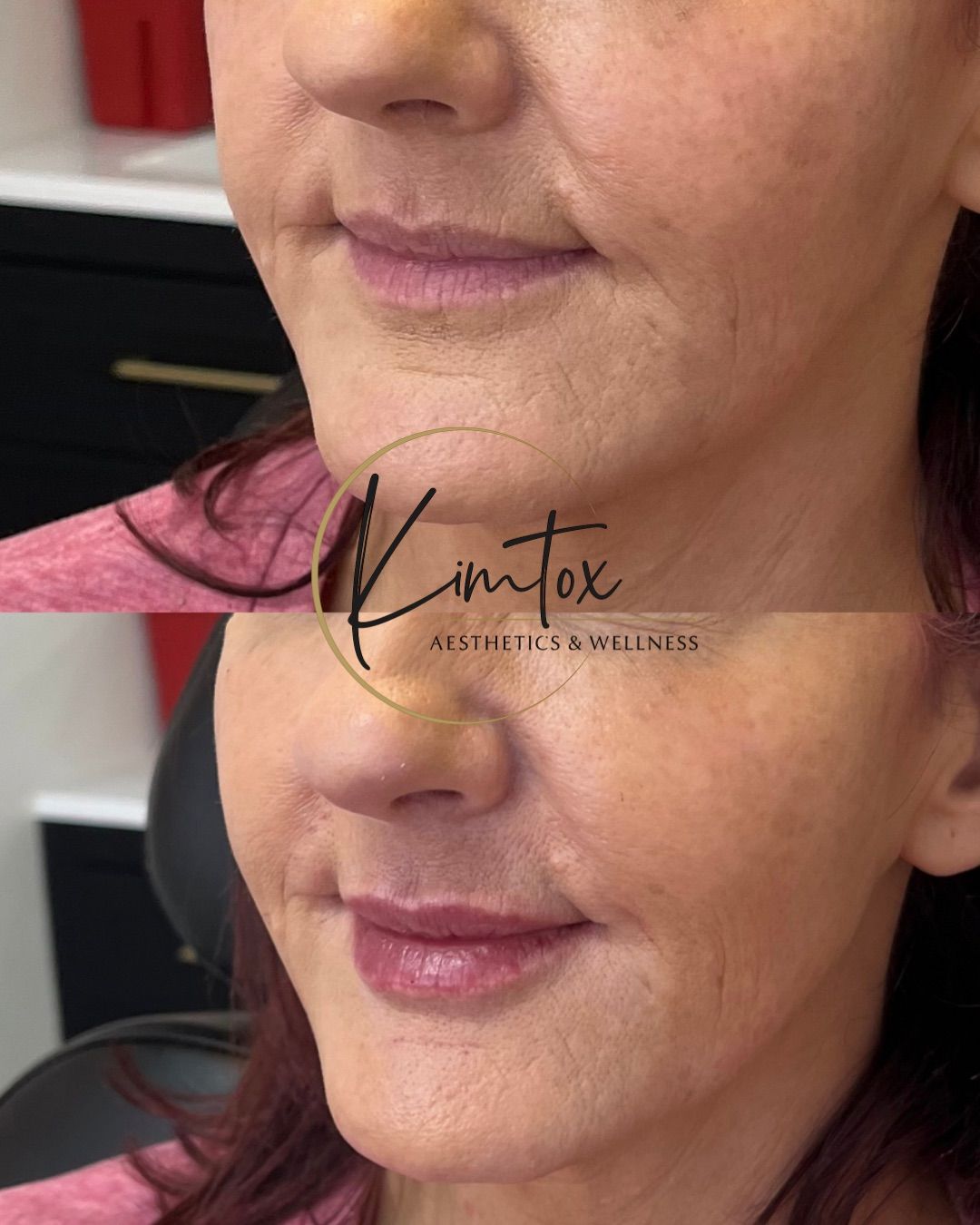 Before-and-after close-up of a woman’s lower face, showing smoother skin and fuller lips after treatment
