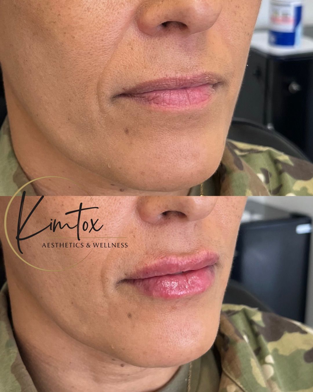 Before-and-after close-up of lips showing fuller, smoother appearance.