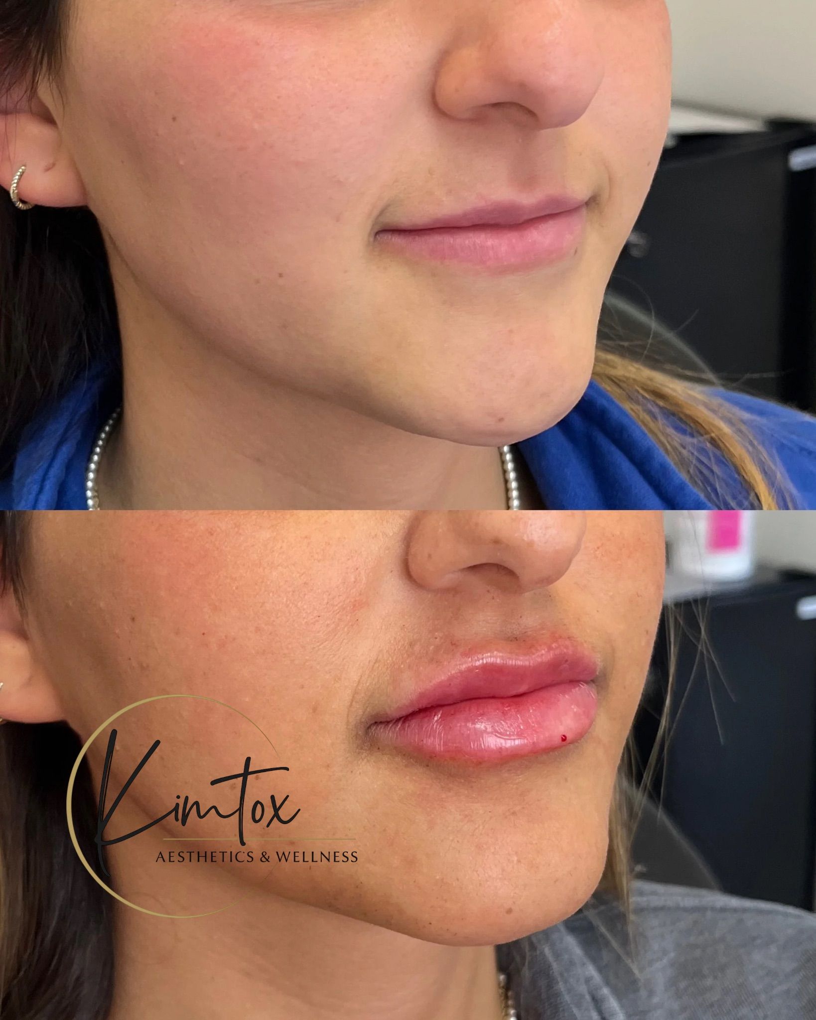 Side-by-side close-up of lips before and after lip filler treatment.