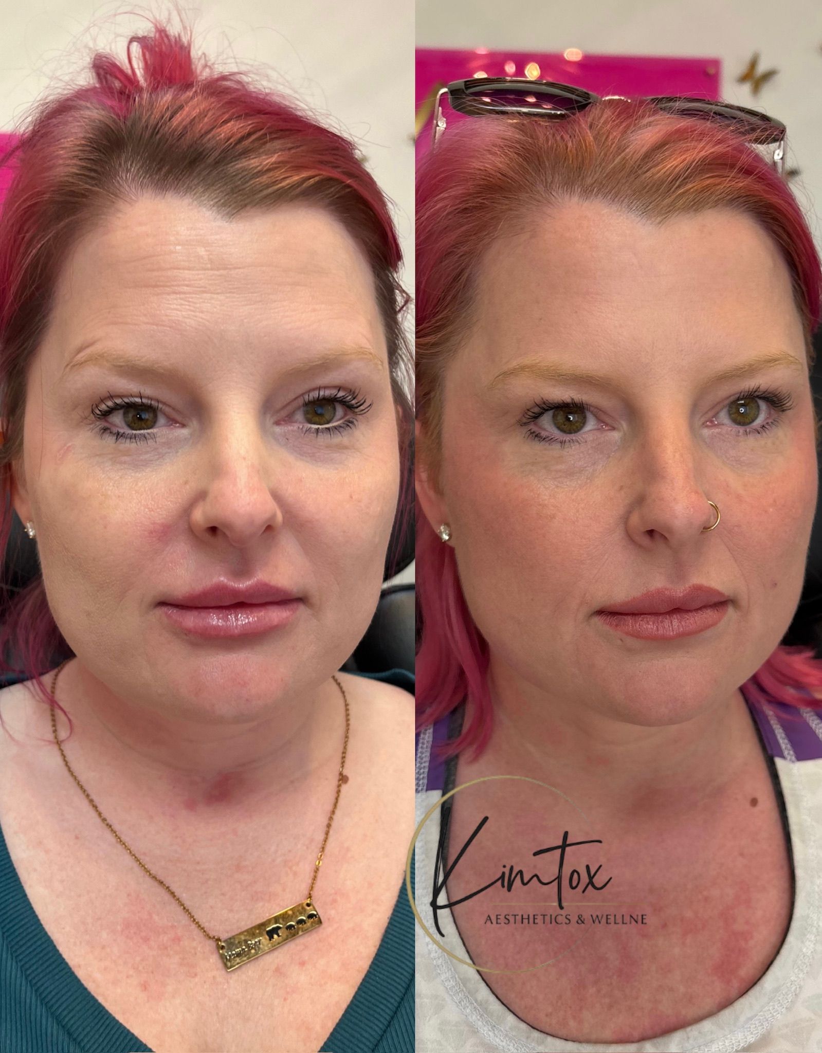 Cool peel results after 3 treatments