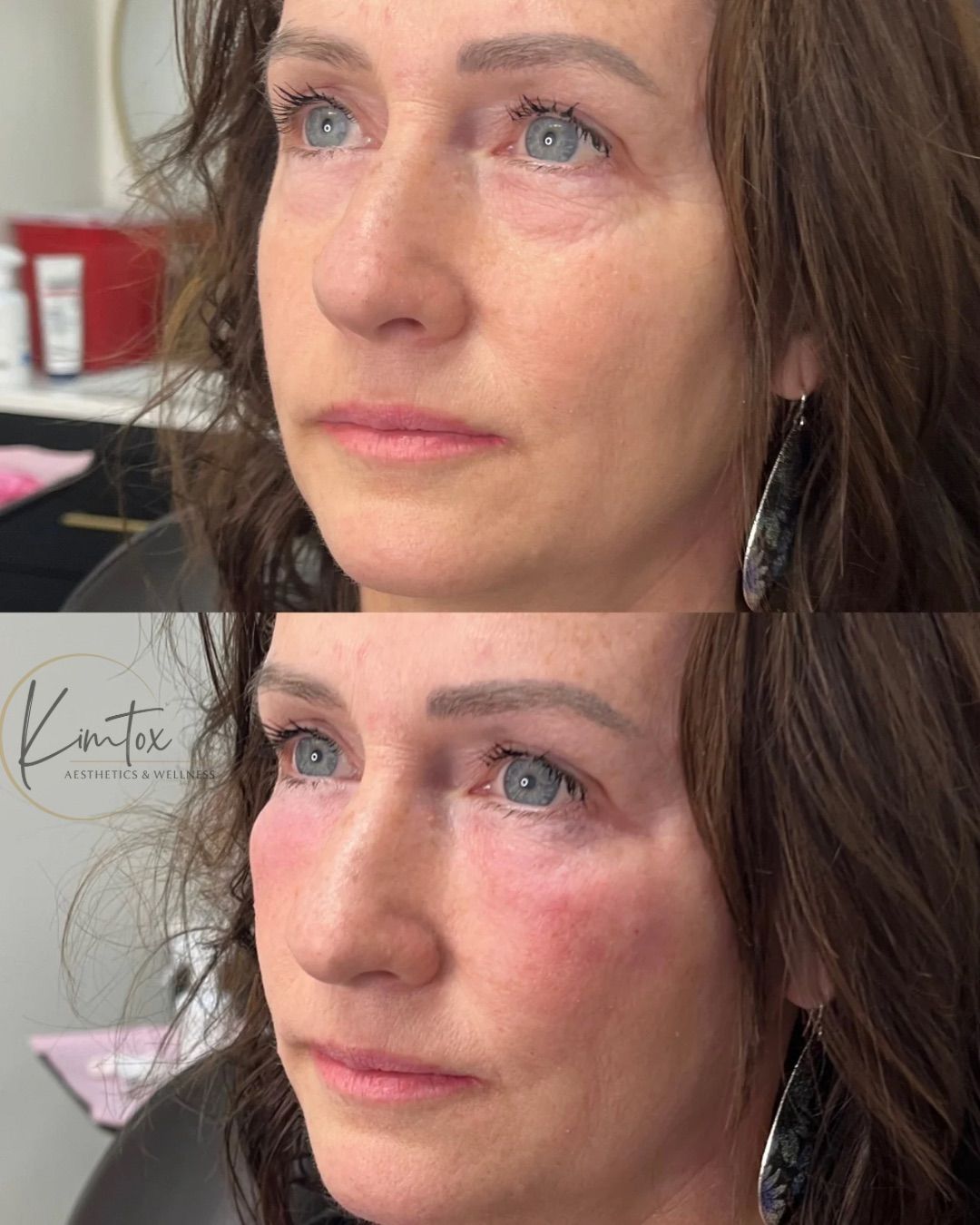 Side-by-side close-up of a woman’s face before and after cosmetic treatment.