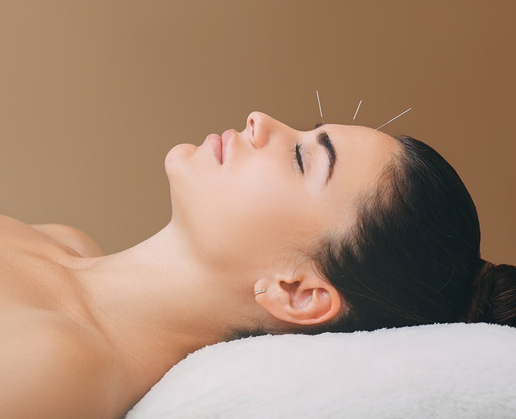 Acupuncture Services — Pinecrest, FL — Beacon Hypnotherapy Institute