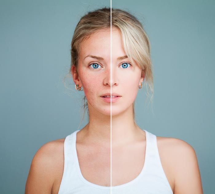 woman before and after acne scar treatment