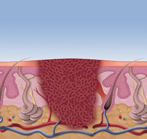 Step-by-step treatment of swift wart removal