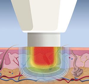 Step-by-step treatment of swift wart removal