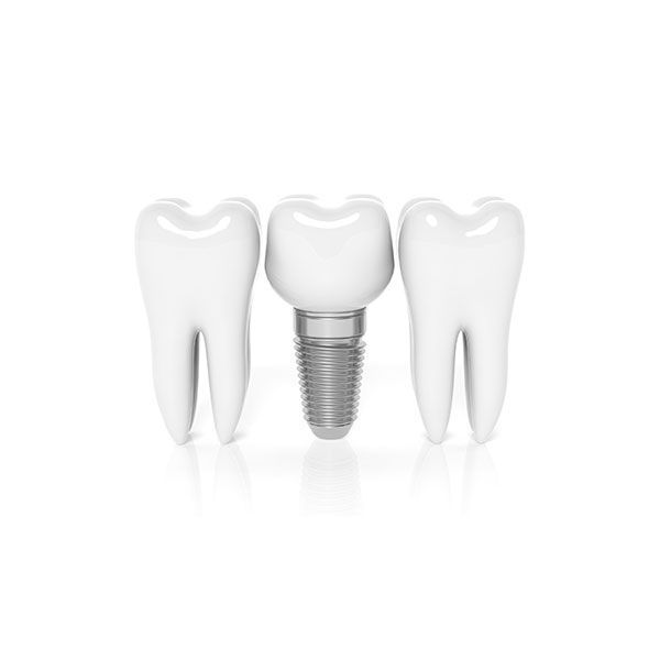 Dantų atkūrimas ant implantų Dantų atkūrimas ant implantų