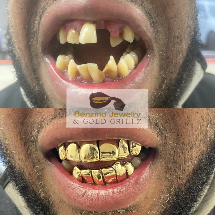 gold grills