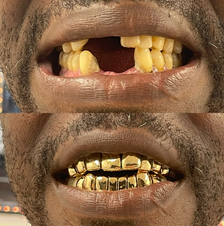 fronts teeth