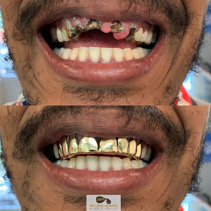 Before and after smile showing missing teeth and gold grillz cover