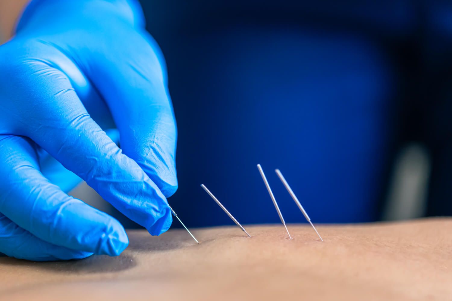 Una persona está recibiendo acupuntura en su brazo.