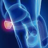 DR. HILDEBRANDO BARRIOS GARCÍA - Cálculos (piedras)