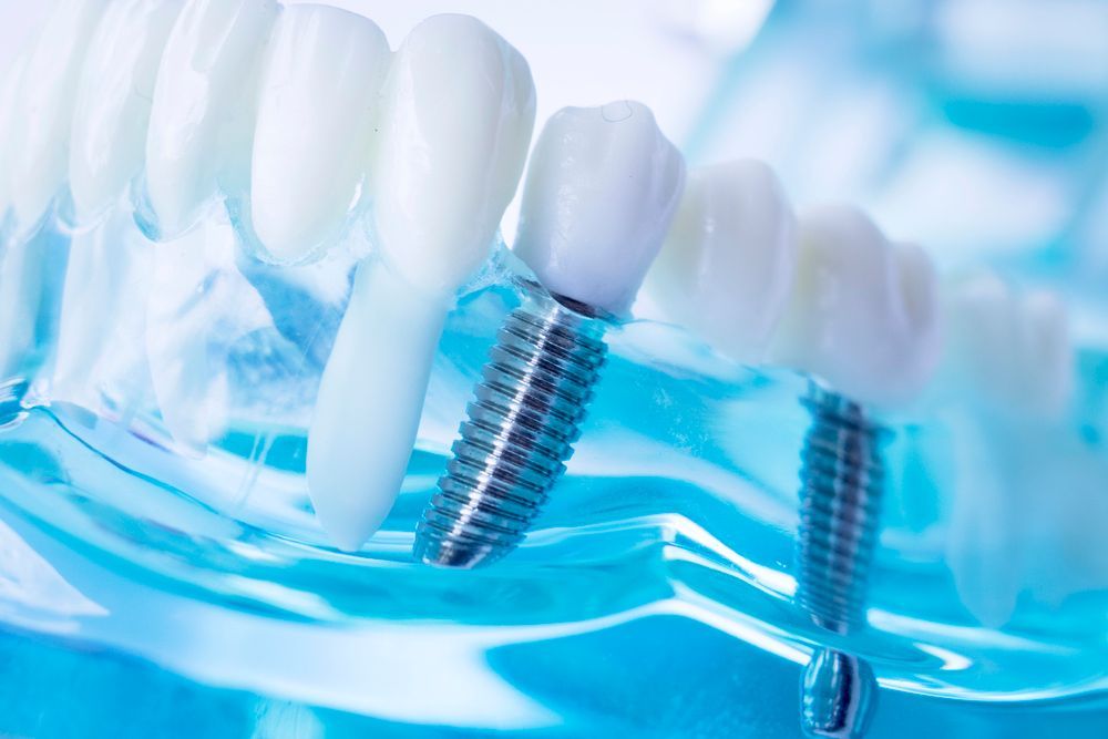 Modello dentale con impianti dentali. Le viti sono visibili.