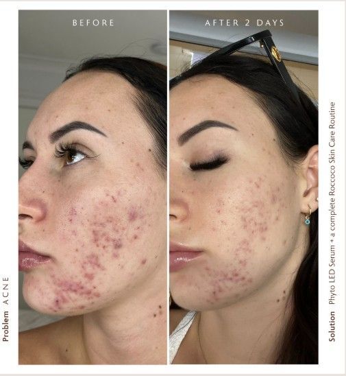 A Before and After Photo of a Woman's Face — Organic Beauty by Kessie in Yeppoon, QLD