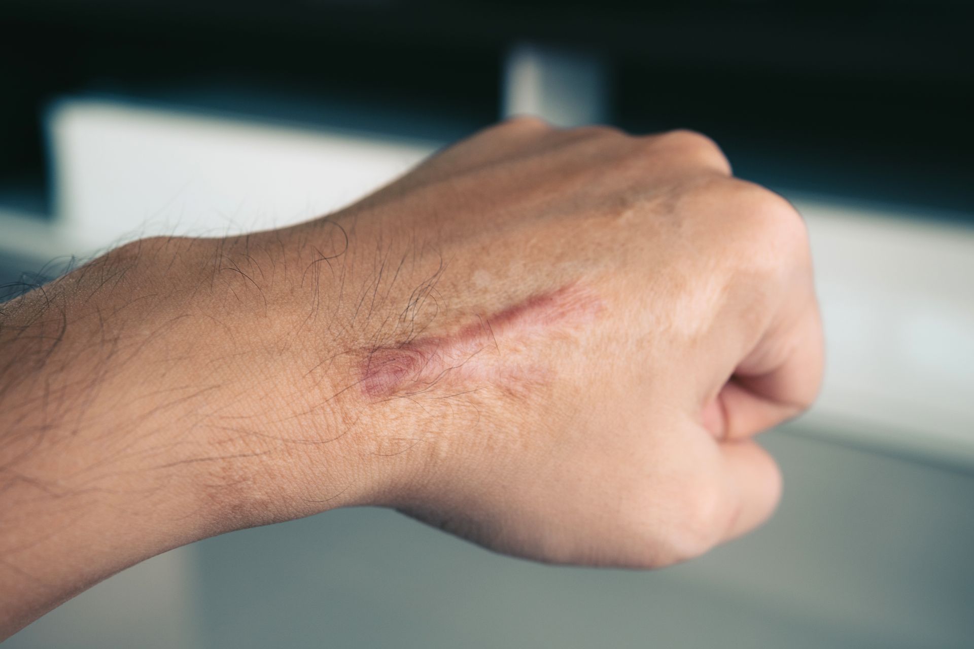A close-up of a human hand showing a linear, reddish, slightly raised scar on the back of the hand.