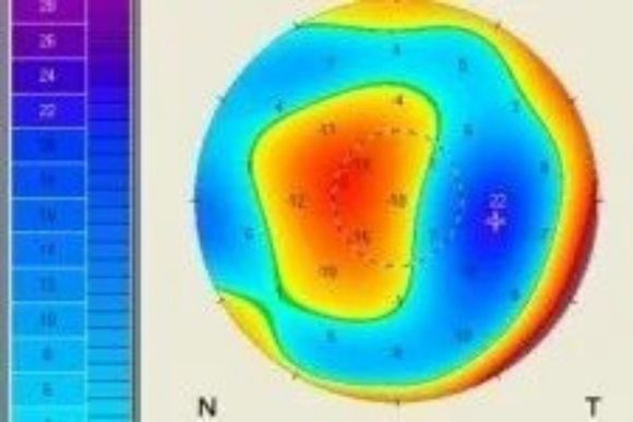 Analisi della cornea