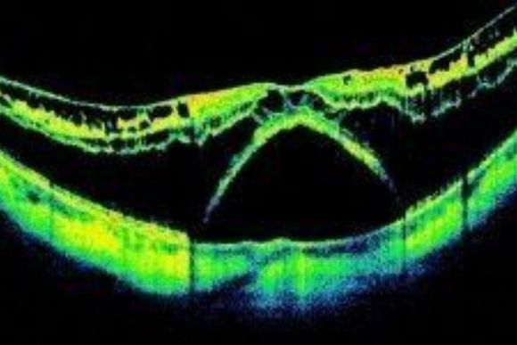 Tomografia a coerenza ottica