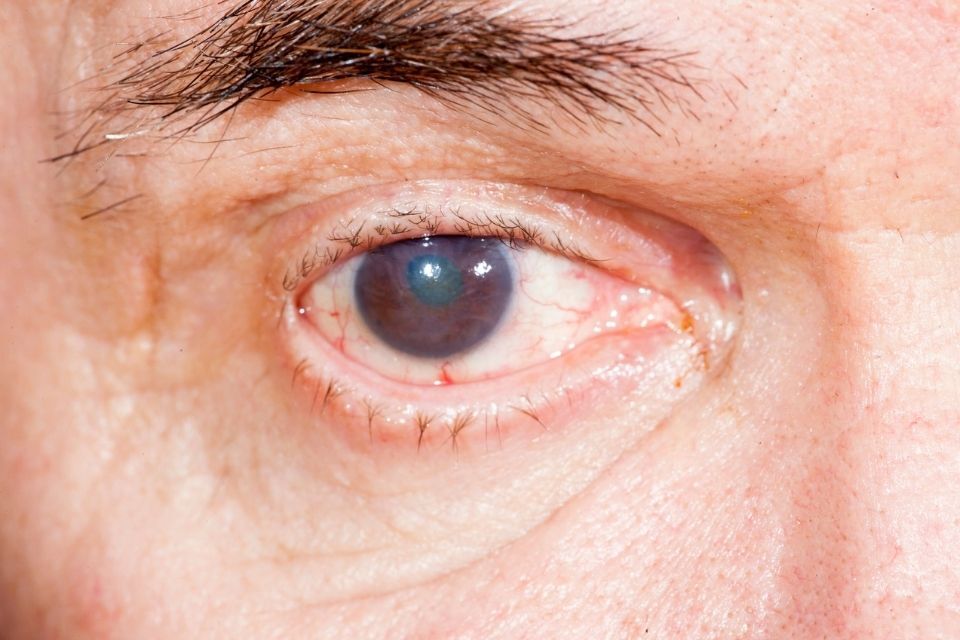 diagnosi della cataratta