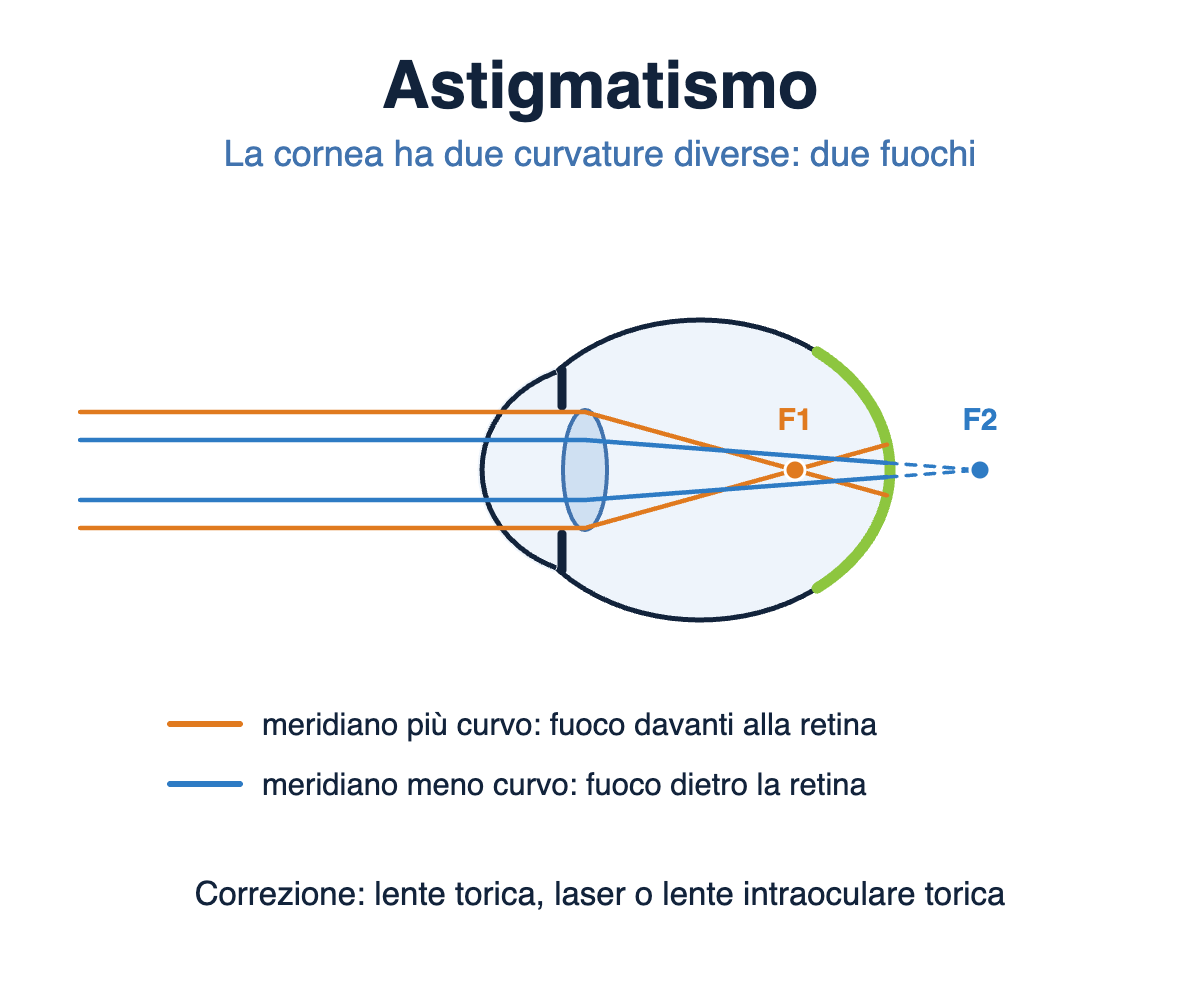 Schema dell'astigmatismo: la cornea ha due curvature diverse e forma due fuochi; si corregge con lente torica, laser o lente intraoculare torica