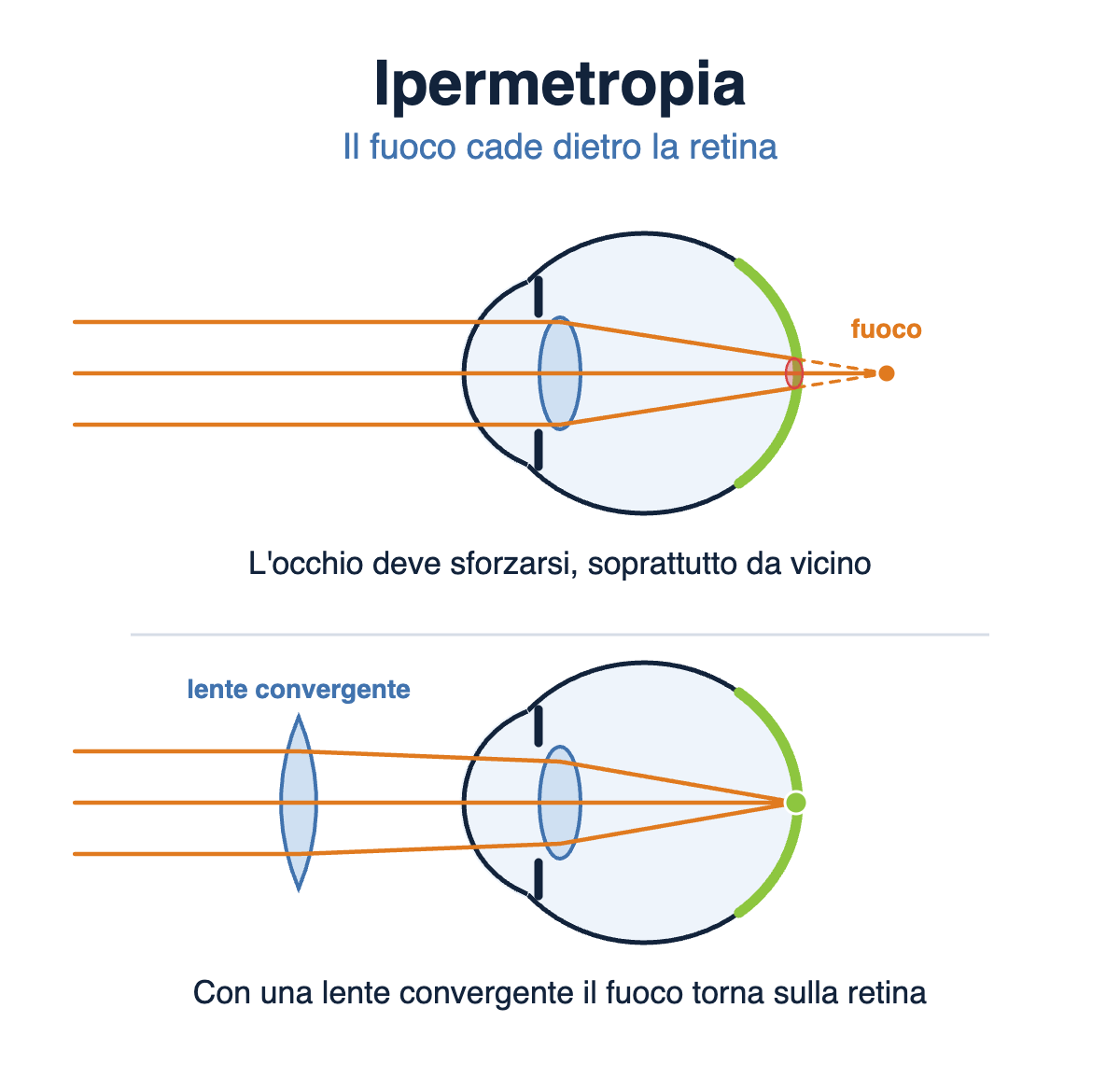 Schema dell'occhio ipermetrope: il fuoco cade dietro la retina; con una lente convergente torna sulla retina