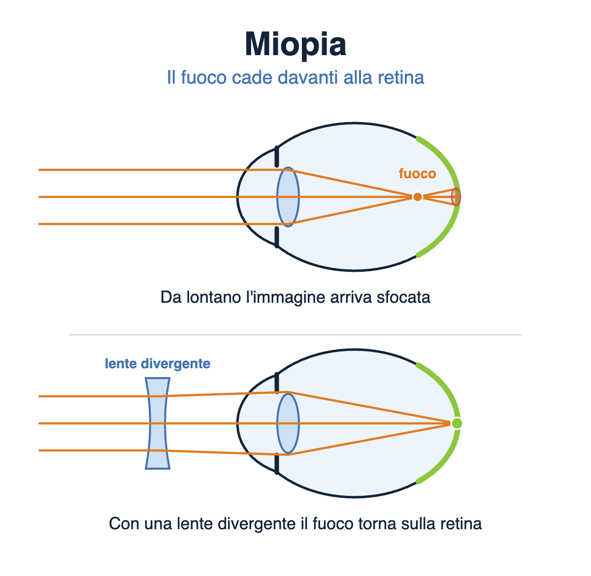 Schema dell'occhio miope: il fuoco cade davanti alla retina; con una lente divergente torna sulla retina