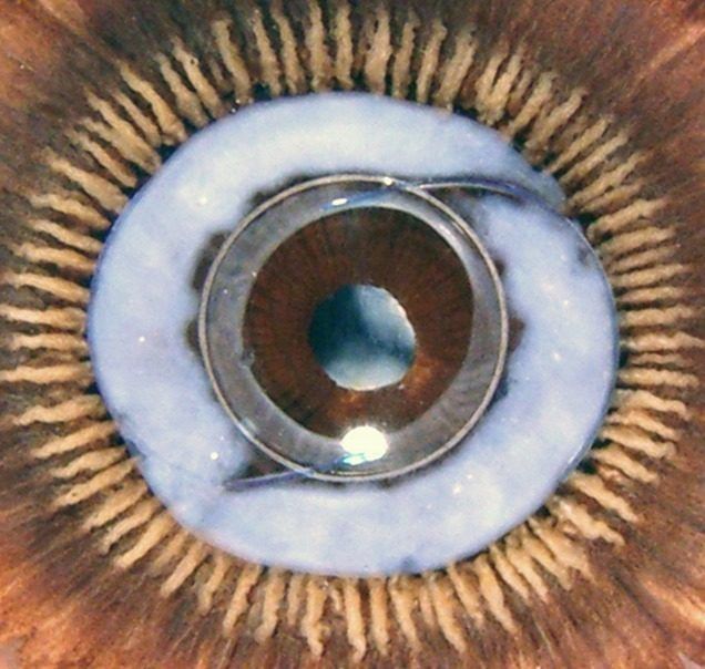 Occhio con lente intraoculare impiantata