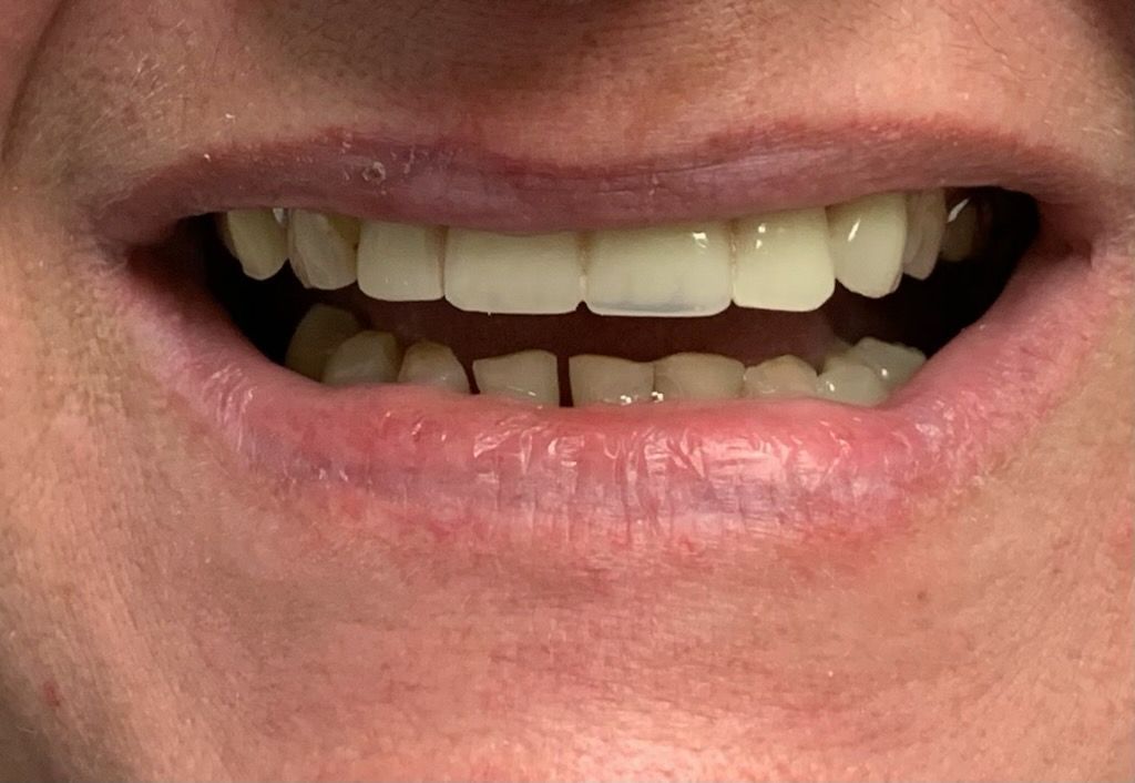 Close-up of a person's smiling mouth, showing teeth and lips; skin is reddish.