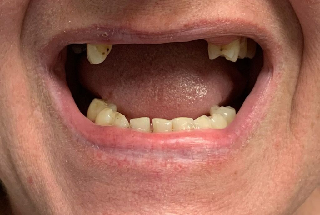 Open mouth of a person with missing teeth, showing the upper and lower gums and tongue.