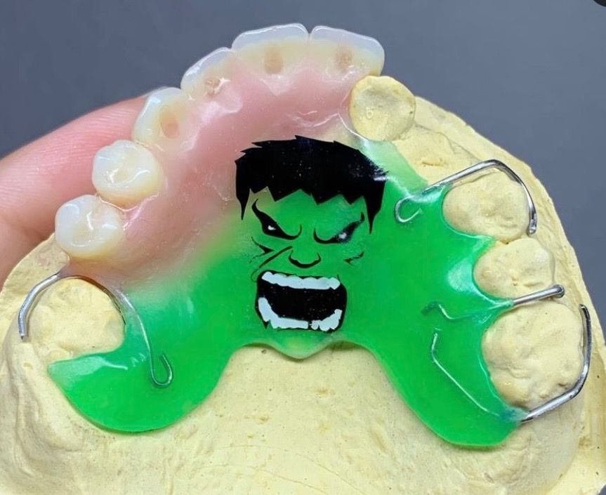 Upper partial denture with Hulk face design, green and black, sitting on plaster dental mold.