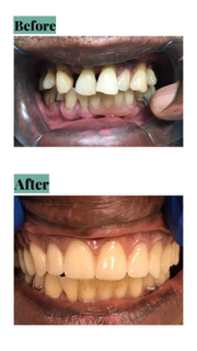 Before/after of teeth. Upper shows yellowing, crooked teeth. Lower shows bright, aligned, pearly white teeth.