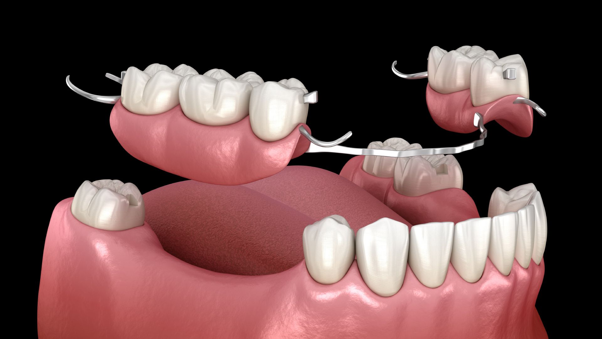 A computer generated image of a denture in a person 's mouth.