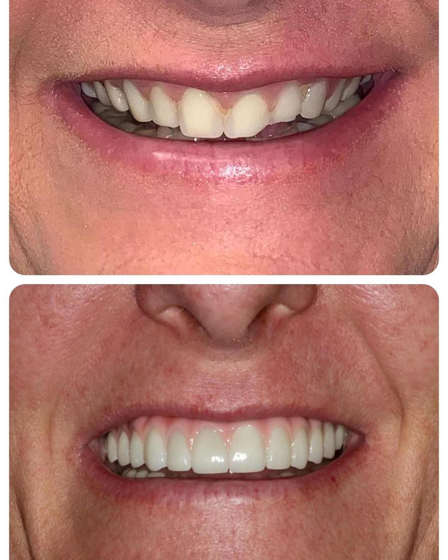 A before and after picture of a woman 's teeth.