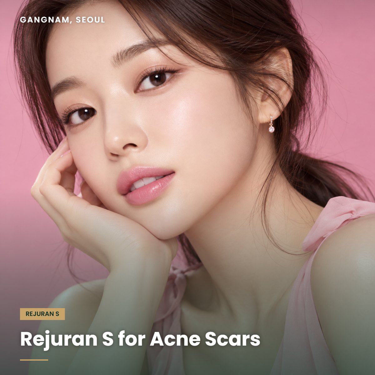 Rejuran S for acne scars at YAAN Clinic Gangnam, Seoul