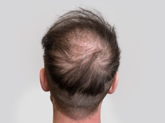 The back of a man 's head with a bald spot.