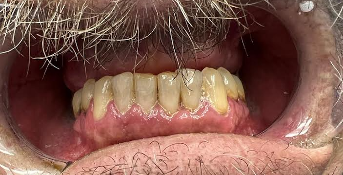 Before Full Mouth Rehabilitation