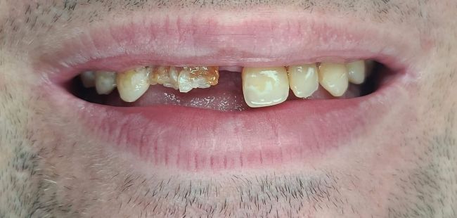 Before Full Mouth Rehabilitation