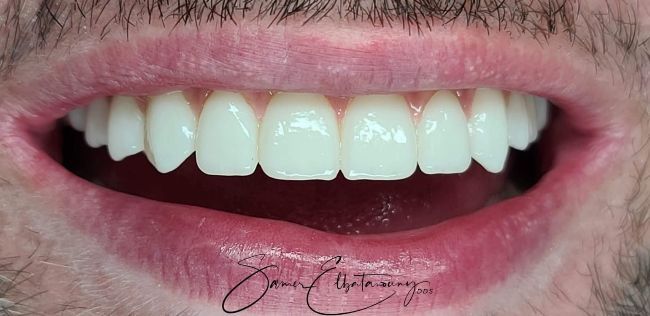 After Full Mouth Rehabilitation